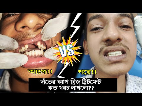 ভিডিও: আলগা ফিটিং দাঁতের কি গ্যাস হতে পারে?