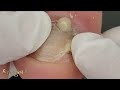 VOCÊ NÃO VAI ACREDITAR! FEZ ESMALTAÇÃO EM GEL NA UNHA E ACONTECEU ISSO! #nails #ingrowntoenail