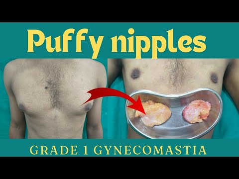 Puffy nipples - Grade 1 Gynecomastia treatment in Ranchi| puffy nipples