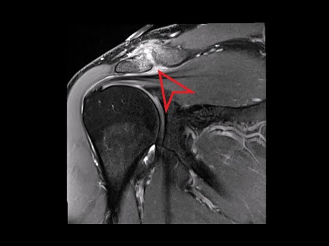 Shoulder MRI: Acromioclavicular (AC) Joint Inflammation