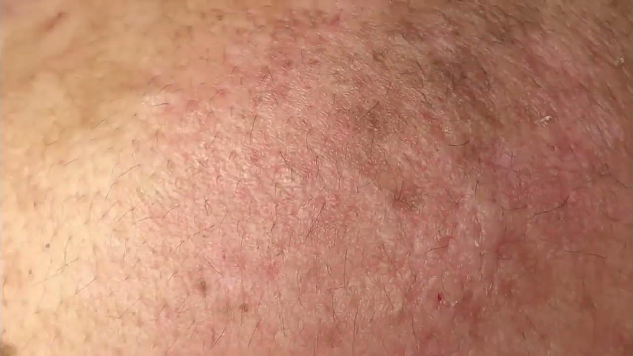 acne Blackheads Whiteheads Removal Blackhead extraction enilsa