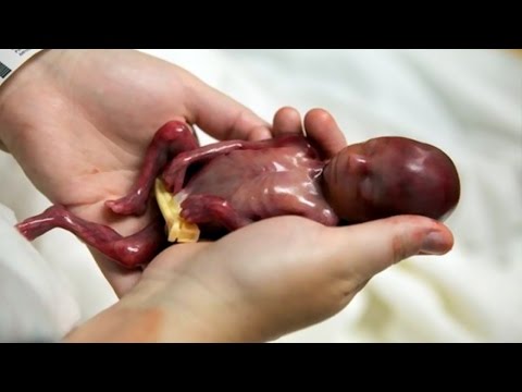 إذا سقط الجنين فى حدود اربعة اشهرفهل ي عق عنه