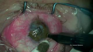 Queratopigmentacion o Tatuaje corneal