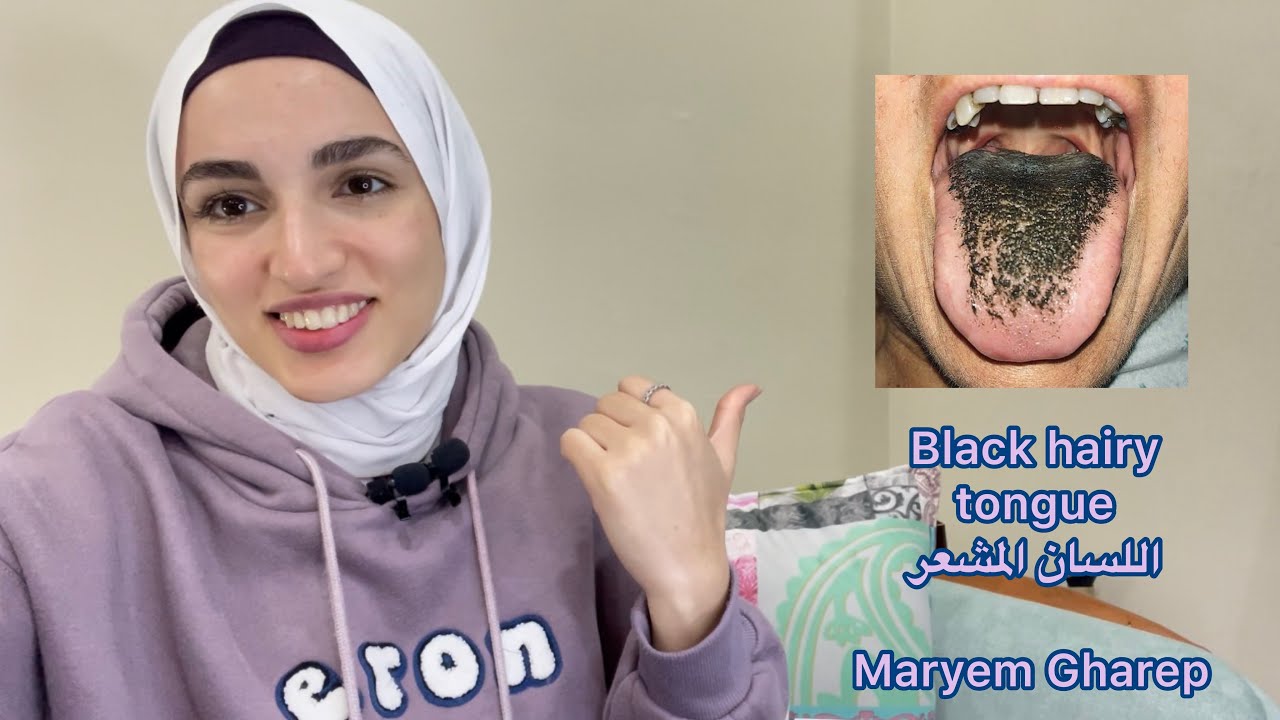 في ٣ دقائقاللسان المشعر Black Hairy Tongue 👅🦷 Youtube