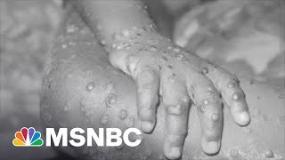 Monkeypox Is Stateside, Should We Be Worried? | Zerlina.