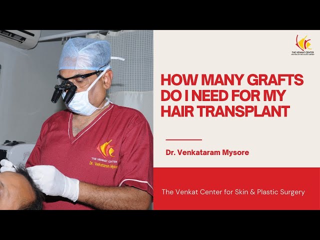 What is the cost of hair transplantation? How is the graft needed for a hair transplant calculated?