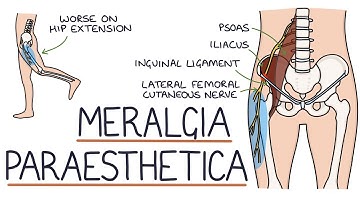 Understanding Meralgia Paraesthetica