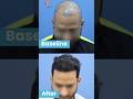 Hair Transplant Results | Hair Transplant in Delhi &amp; Bhubaneswar | Alloroots