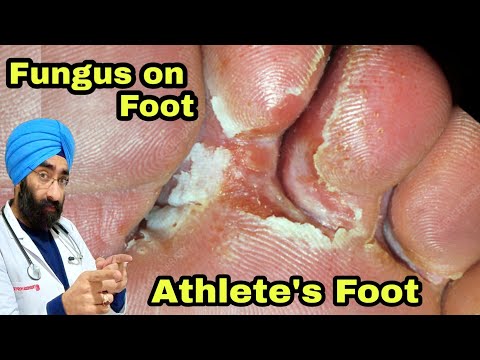 Athlete&rsquo;s foot | Fungal Foot Infection | Tinea pedis | 100% Science | Dr.Education (ENG)