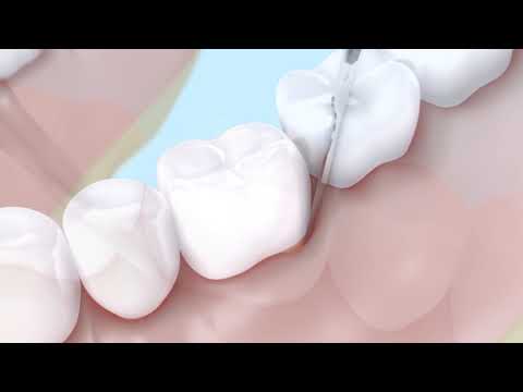 Операция №4  Консервация альвеолы после удаления зуба с кистой, цистэктомия