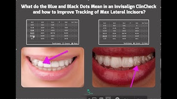TMT, Tracking of Max Lateral Incisors and what are the Blue and Black Dots in ClinCheck