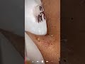 Skincare | Blackheads Removal #585 #tweezers skincare #blackheads blackheads