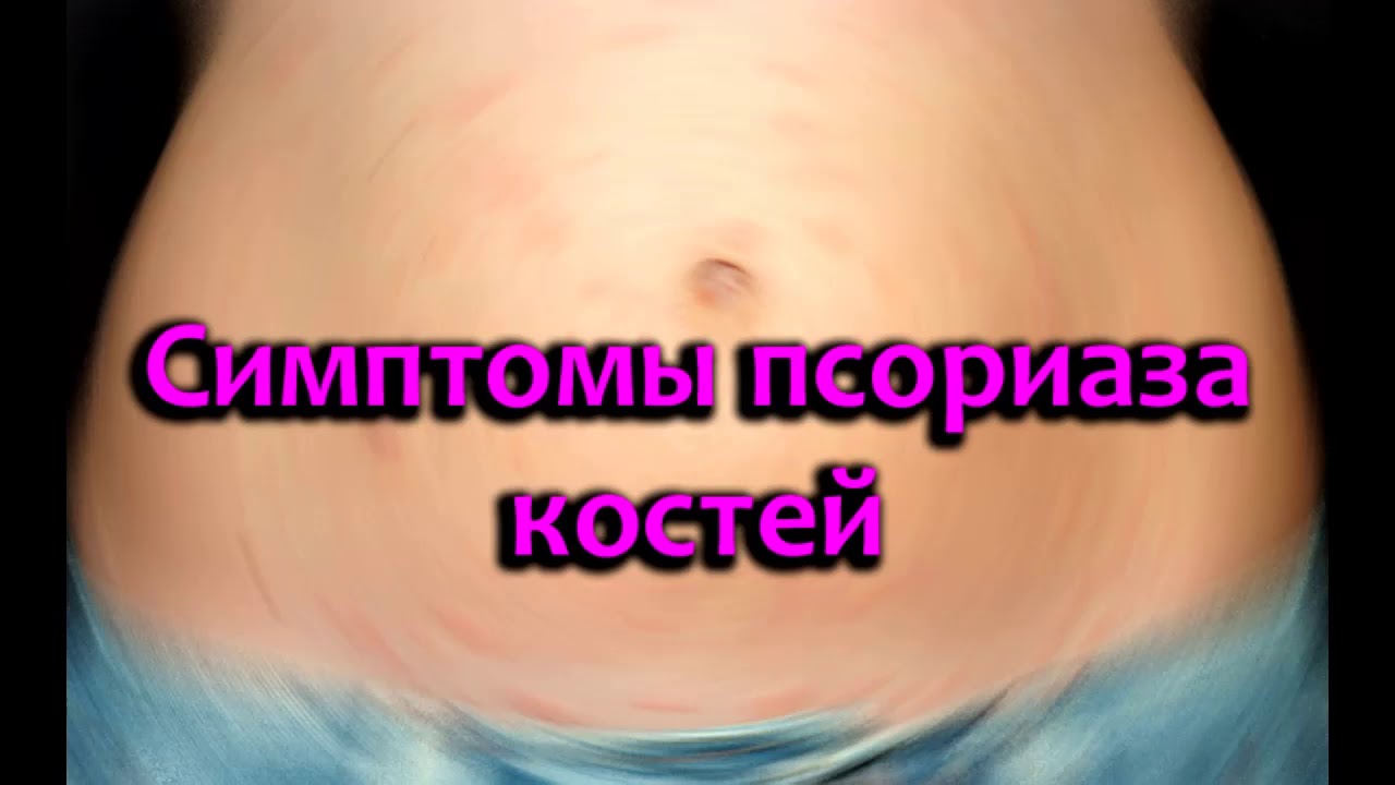 Первые признаки псориаза у женщин - причины и лечение (фото)