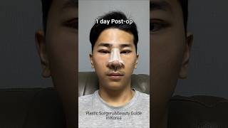 I got my first eye and nose surgeries to become an influencer. Did it turn out well? #shorts #fyp