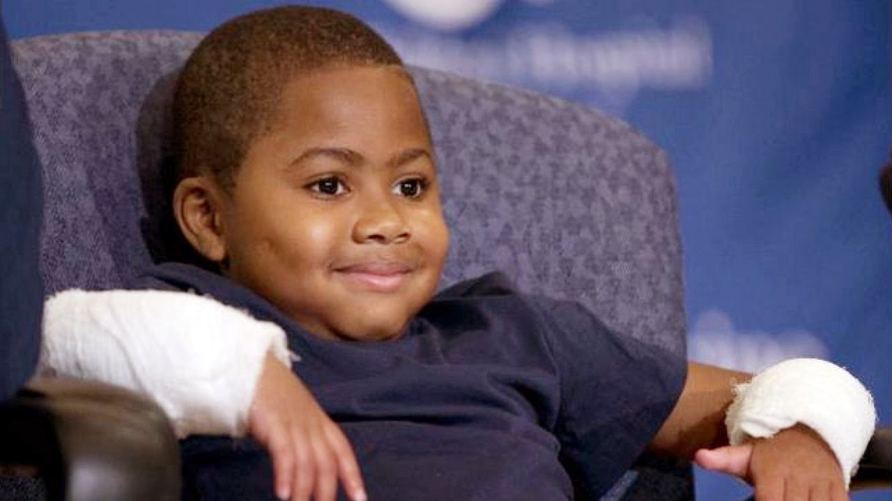 El niño de 8 años que recibió un doble trasplante de manos