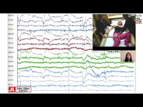 JOURNAL CLUB -Diagnostic diferențial al fenomenelor paroxistice  epileptice si neepileptice.