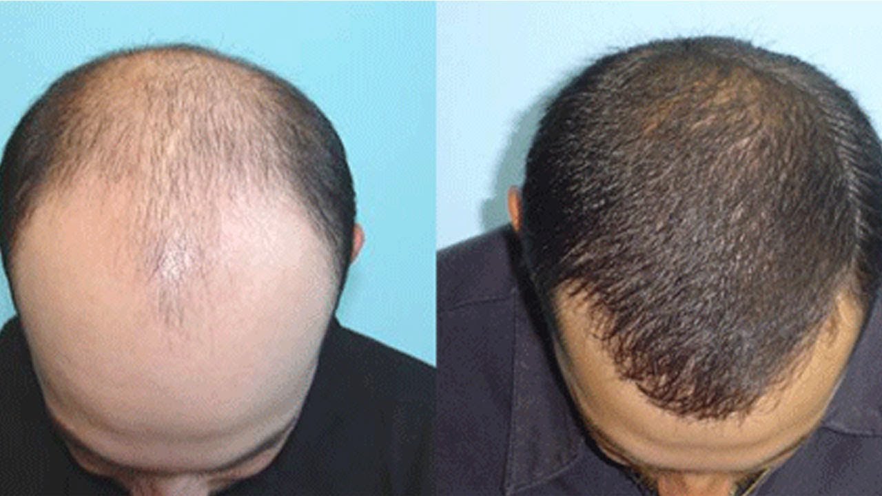 Best Onion Hair Mask For Extreme Hair Growth | Promote Hair Growth | Hair Oil  For Hair Loss Problem