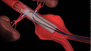 What is Fenestrated Endovascular Aortic Repair (FEVAR)?
