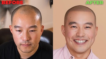Scalp Micropigmentation 2 YEARS LATER