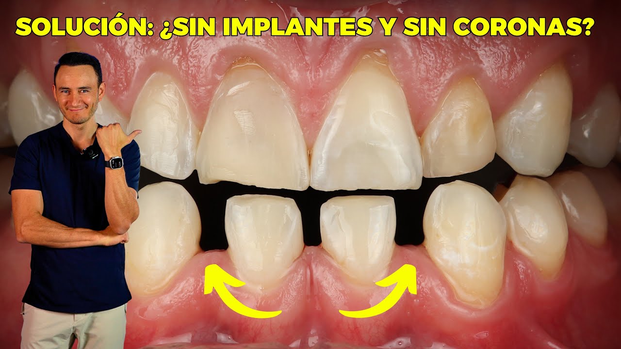 ¿Te faltan dientes y no quieres Implantes, coronas o removibles? Solución Caso Real