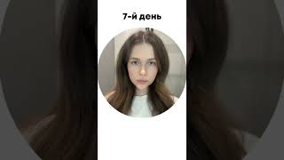 #релатокс #ботулинотерапия #ботокс