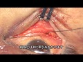 ※手術動画です 眼窩下壁骨折整復術(経結膜) 17 mins orbital floor reconstruction with transconj approach