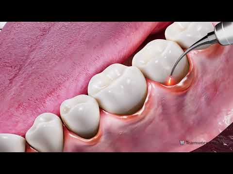 Laser-Focused Hygiene: Advancing