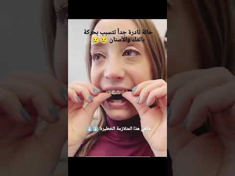 حالة نادرة تؤثر على انسجة الضامة والمفاصل والفك والاسنان وتسبب بحركتها طبيبة اسنان ابتسامةهوليود