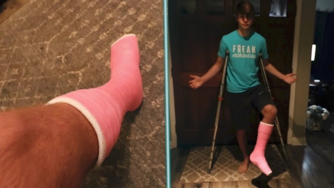I GOT MY FIRST EVER CAST! (Broken Ankle)