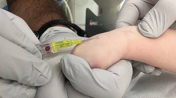 IV Insertion Technique in Infants and Small Children