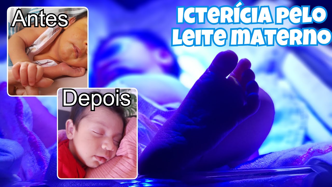 MINHA BEBÊ TEVE ICTERÍCIA | COMO TUDO ACONTECEU - ICTERÍCIA PELO LEITE ...