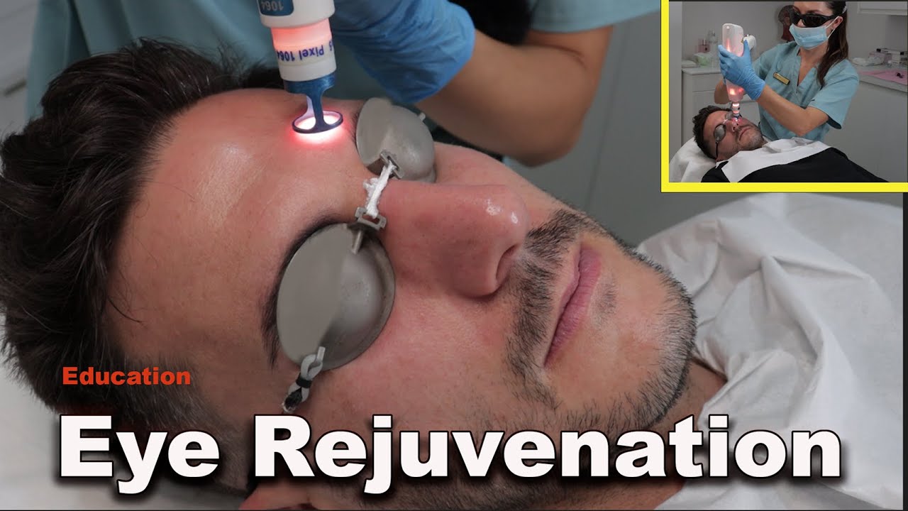 Процедура омоложения кожи вокруг глаз с помощью лазера — удаление мешков под глазами и подтяжка в...