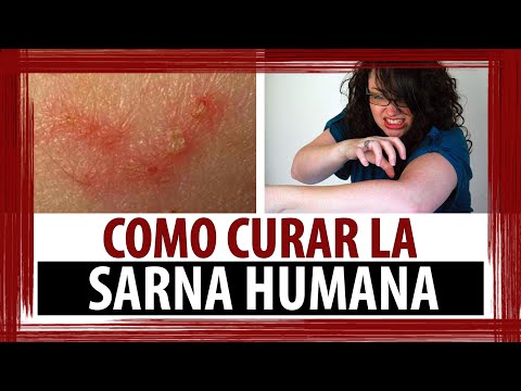 Atopichesky la dermatitis sobre la planta