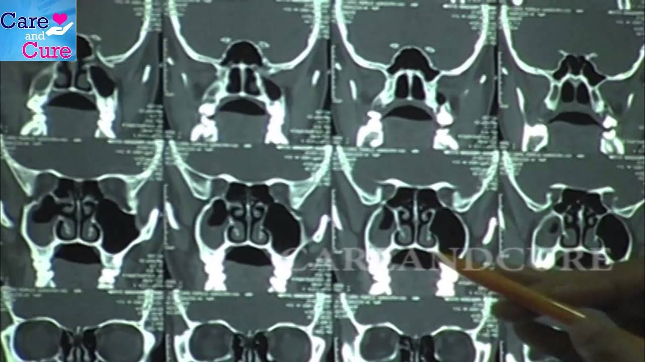 CT SCAN SINUSITIS | MEDICAL TEST | DR SHAKUNTALA - YouTube