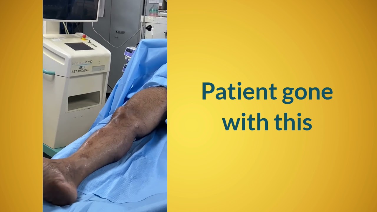 Varicose Vein Counselling Video | Symptoms of Varicose Veins | Varicose Veins Specialists |