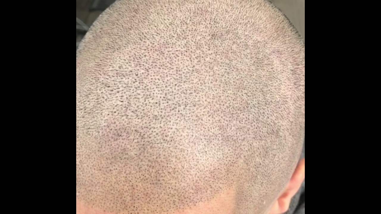 Insane close up Scalp-micropigmentation head tattoo /SMP ...