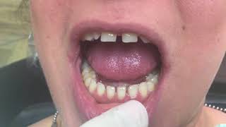 Houston Cosmetic Dentist...closing Gaps And Changing Lives ..Snap-On Smile