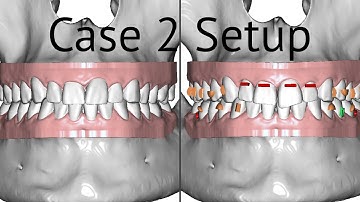 Maestro 3D aligners virtual setup: case 2, distalization of the upper teeth