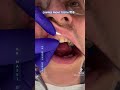 Chipped Front Tooth 🦷😬