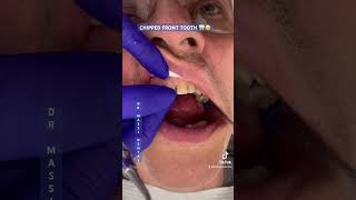Chipped Front Tooth 🦷😬...