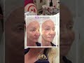 Cheek Hollowness and Under Eye Problem? HOW TO FIX!