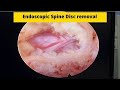Endoscopic Spine Disc Removal.