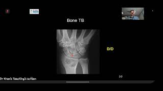 MSK for FRCR Examination-DKT Masterclass Made Easy For All-Infection, AVN and Miscellaneous Part-2