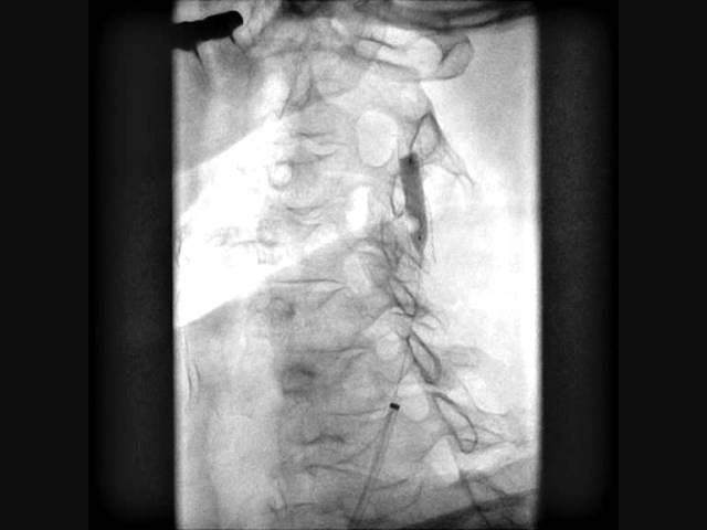 Стентирование сонных артерий