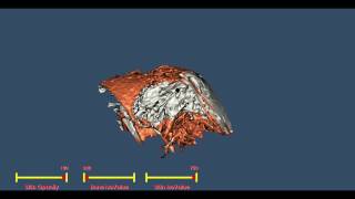 VTK Shoulder Reconstruction