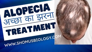 Alopecia areata kya hota hai | alopecia treatment in Hindi | Symptoms and diagnosis of alopecia