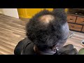 She has Alopecia and her hair won’t grow back| Alopecia Transformation and full instruction