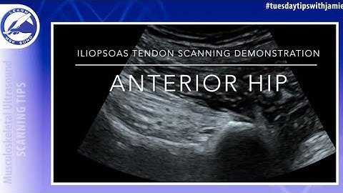 Iliopsoas Tendon Hip Scanning Demonstration- MSK Ultrasound