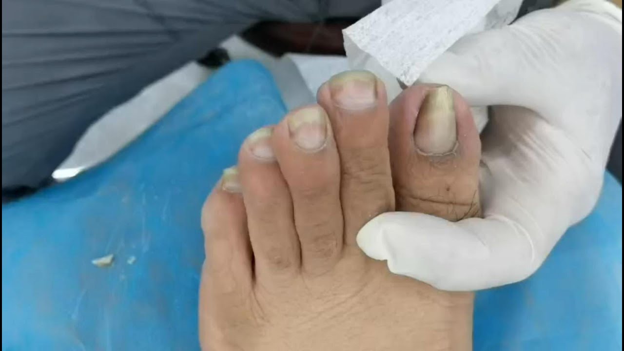 Hoof trim! Look at the curved nail, in especial the curved big toenail