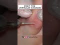 PINKY TOE VERRUCAE EXCISION